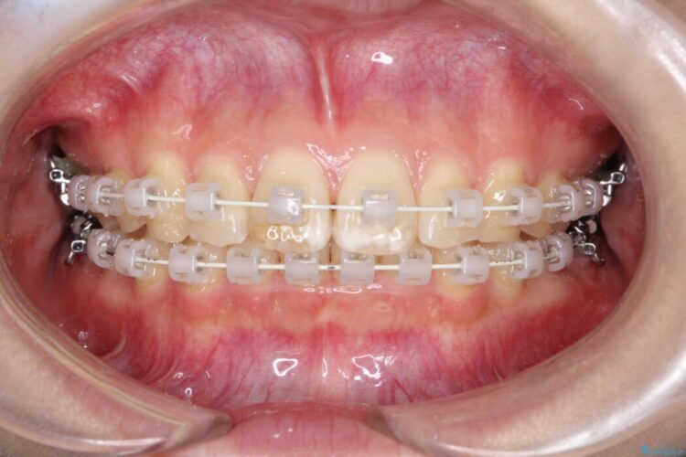 ねじれた前歯を非抜歯ワイヤー矯正で改善 治療途中画像