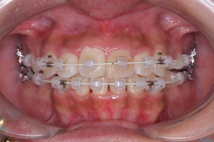 突出感のある口元、抜歯矯正で理想的な横顔に 治療途中画像