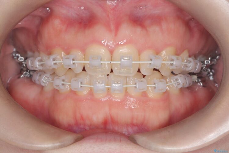 歯を削らない矮小歯を考慮した非抜歯矯正 治療途中画像