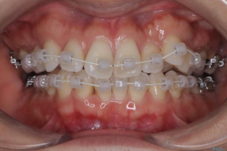 非抜歯で叢生とシザーズバイトの改善 治療途中画像