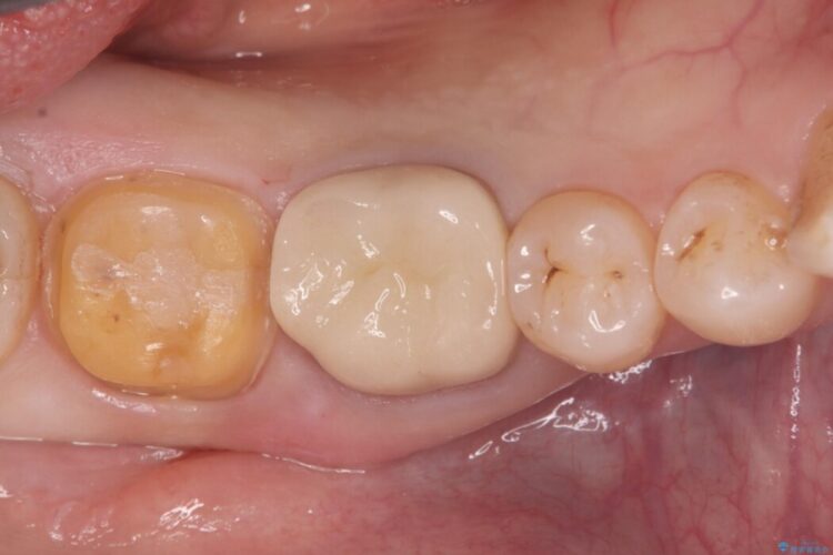 銀歯の下で進行した虫歯、セラミッククラウンでやり替え 治療途中画像
