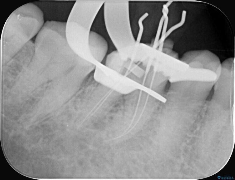 強い痛みと腫れを伴う「曲がった根っこ」を精密根管治療 治療途中画像