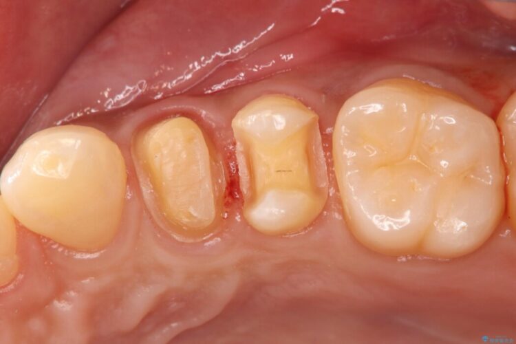 「痛み」を「安心」に。銀歯を外して行う、最新の精密根管治療 治療途中画像