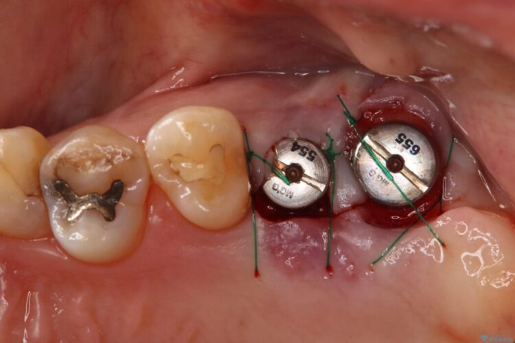 1Dayインプラント治療による咬合の再構築 治療途中画像