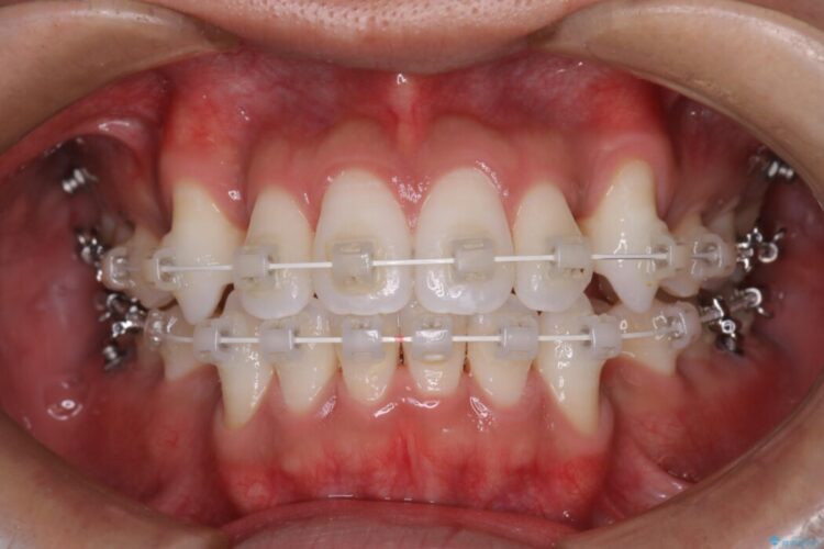 ガタつきと口元の突出感を抜歯ワイヤー矯正で改善 治療途中画像
