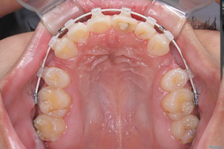 突出感のある口元、抜歯矯正で理想的な横顔に 治療途中画像