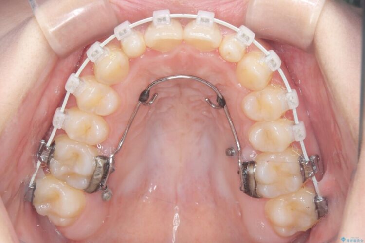 歯を削らない矮小歯を考慮した非抜歯矯正 治療途中画像