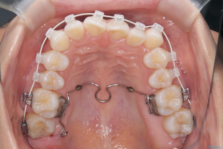 非抜歯で叢生とシザーズバイトの改善 治療途中画像