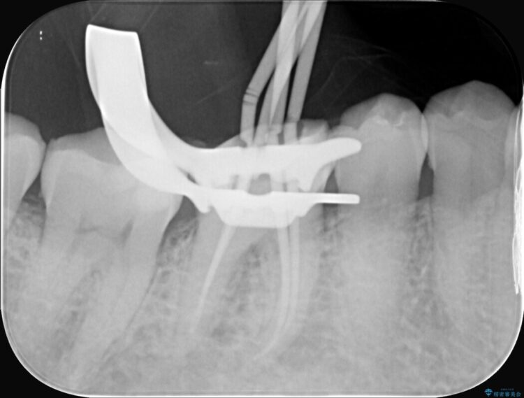 強い痛みと腫れを伴う「曲がった根っこ」を精密根管治療 治療途中画像