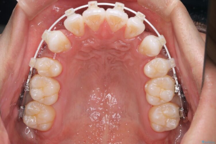 ガタつきと口元の突出感を抜歯ワイヤー矯正で改善 治療途中画像