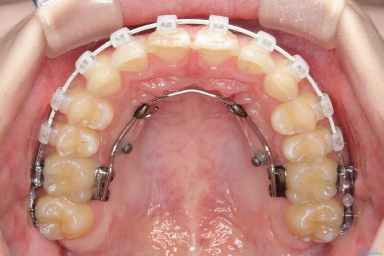 ねじれた前歯を非抜歯ワイヤー矯正で改善 治療途中画像