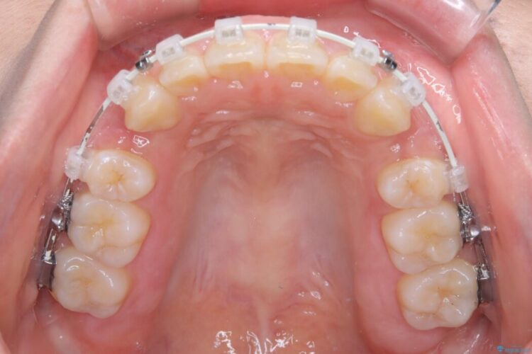 「口元の突出感」を解消。前歯を下げてスッキリした口元へ 治療途中画像