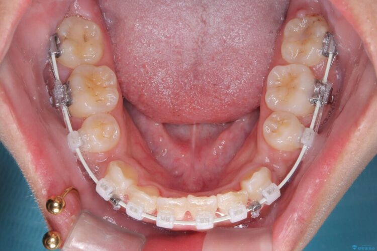 突出感のある口元、抜歯矯正で理想的な横顔に 治療途中画像