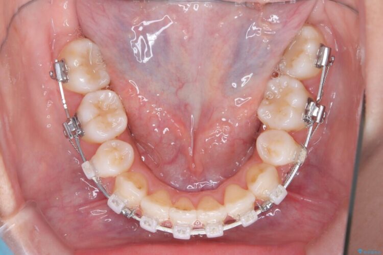 重なり合った歯列を整え、美しい横顔に 治療途中画像