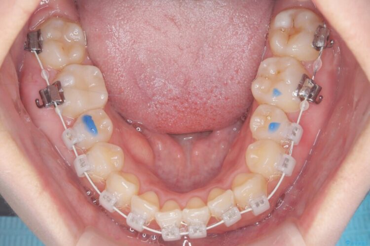 歯を削らない矮小歯を考慮した非抜歯矯正 治療途中画像