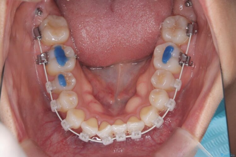非抜歯で叢生とシザーズバイトの改善 治療途中画像