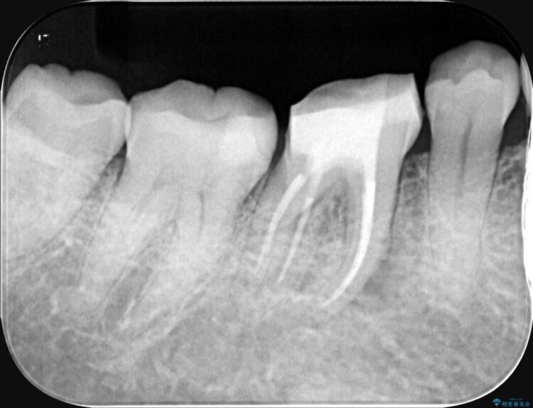 強い痛みと腫れを伴う「曲がった根っこ」を精密根管治療 治療途中画像