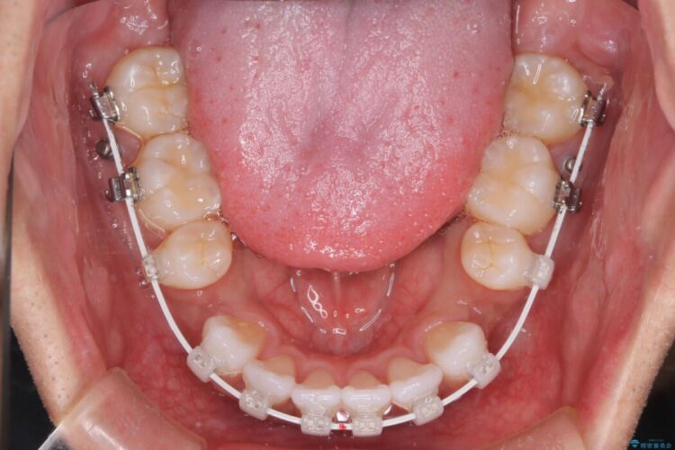 ガタつきと口元の突出感を抜歯ワイヤー矯正で改善 治療途中画像