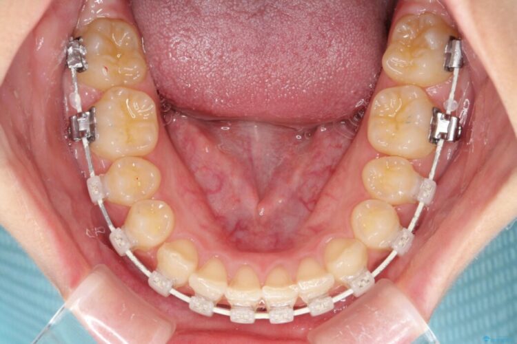 ねじれた前歯を非抜歯ワイヤー矯正で改善 治療途中画像