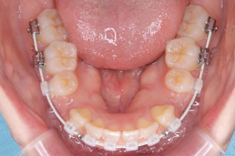 「口元の突出感」を解消。前歯を下げてスッキリした口元へ 治療途中画像