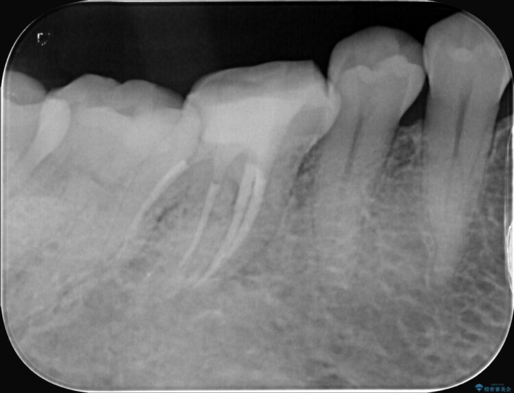強い痛みと腫れを伴う「曲がった根っこ」を精密根管治療 治療途中画像