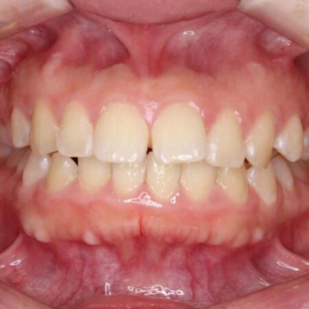 「口元の突出感」を解消。前歯を下げてスッキリした口元へ 治療前