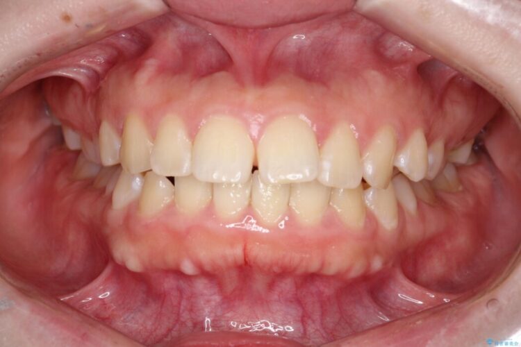 「口元の突出感」を解消。前歯を下げてスッキリした口元へ 治療前画像