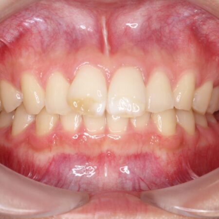 ねじれた前歯を非抜歯ワイヤー矯正で改善 治療前