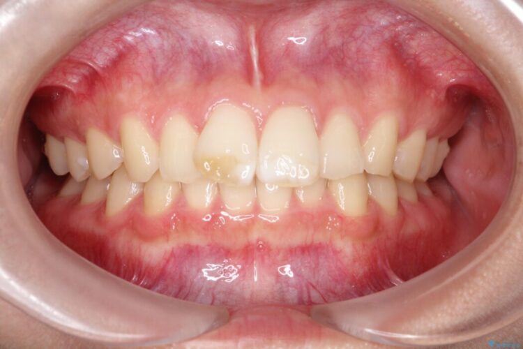 ねじれた前歯を非抜歯ワイヤー矯正で改善 治療前画像