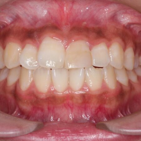 突出感のある口元、抜歯矯正で理想的な横顔に 治療前