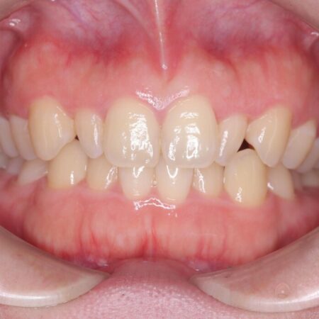 歯を削らない矮小歯を考慮した非抜歯矯正 治療前