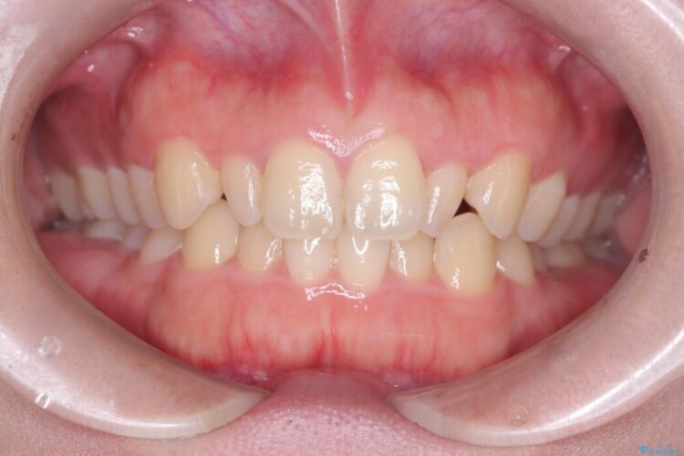 歯を削らない矮小歯を考慮した非抜歯矯正 治療前画像