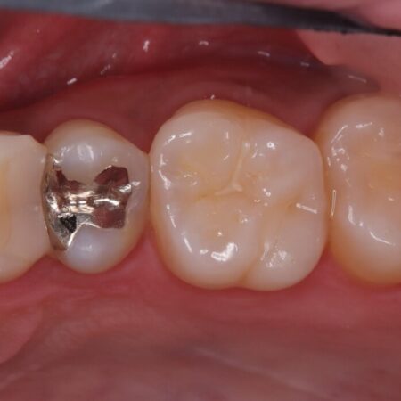 「痛み」を「安心」に。銀歯を外して行う、最新の精密根管治療 治療前