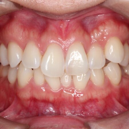 非抜歯で叢生とシザーズバイトの改善 治療前