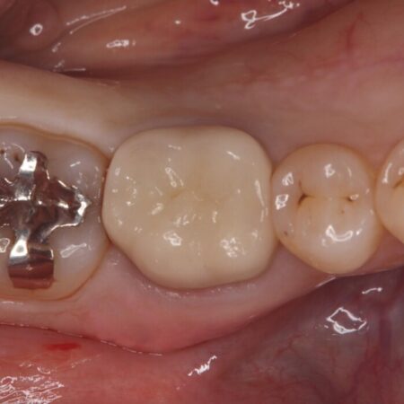 銀歯の下で進行した虫歯、セラミッククラウンでやり替え 治療前