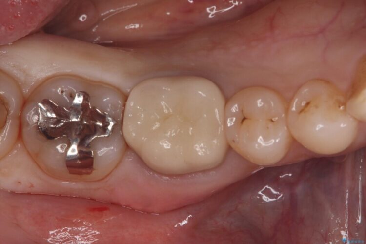 銀歯の下で進行した虫歯、セラミッククラウンでやり替え 治療前画像