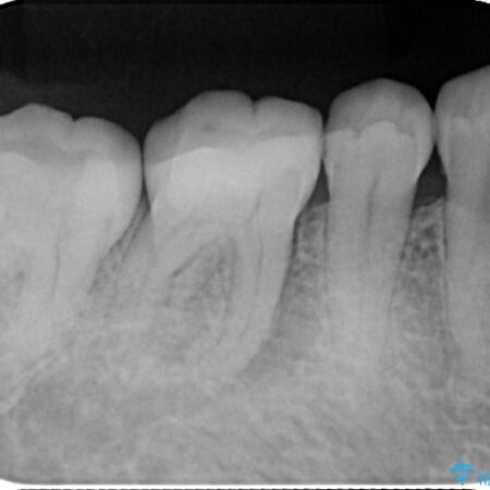 強い痛みと腫れを伴う「曲がった根っこ」を精密根管治療 治療前