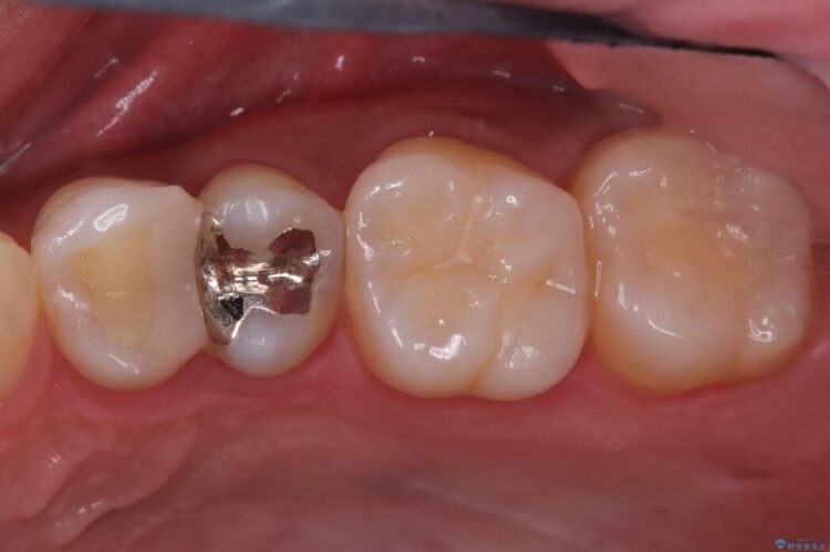 「痛み」を「安心」に。銀歯を外して行う、最新の精密根管治療 治療前画像