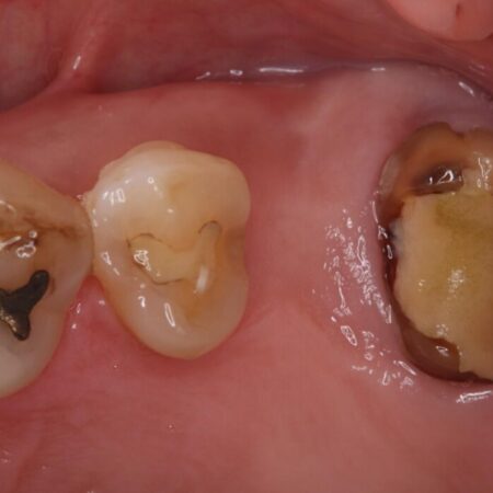 1Dayインプラント治療による咬合の再構築 治療前