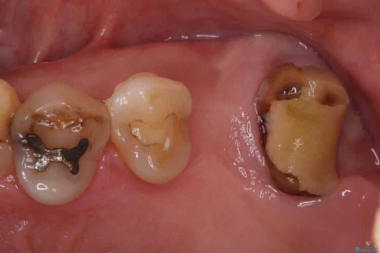 1Dayインプラント治療による咬合の再構築 治療前画像
