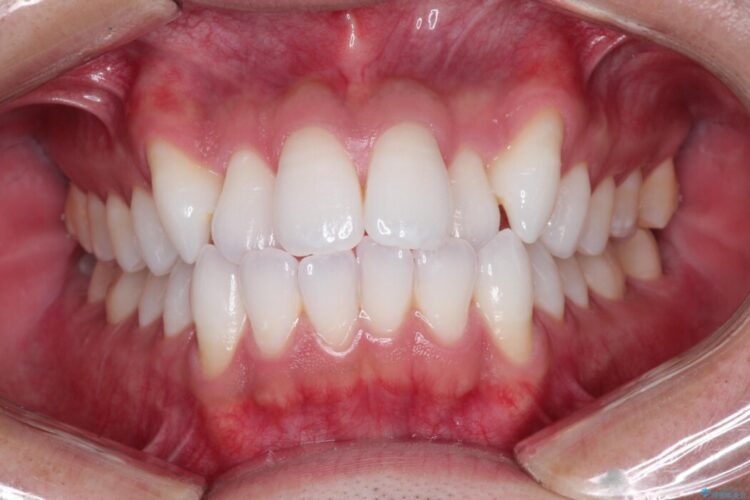 ガタつきと口元の突出感を抜歯ワイヤー矯正で改善 治療前画像