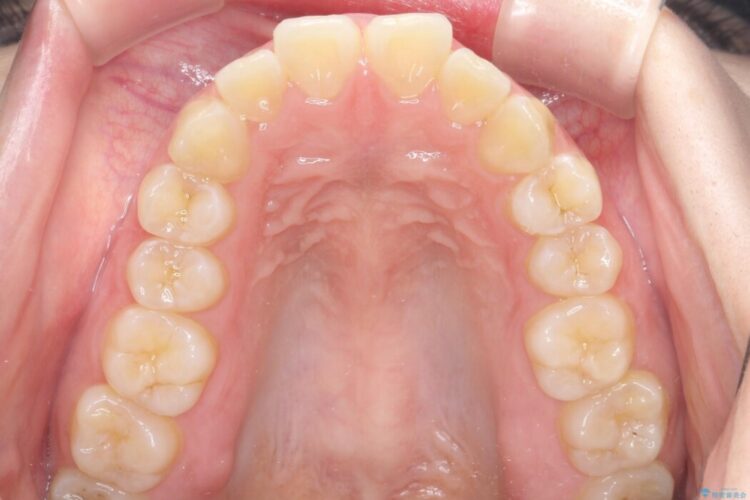 「口元の突出感」を解消。前歯を下げてスッキリした口元へ 治療前画像