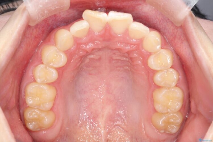 ねじれた前歯を非抜歯ワイヤー矯正で改善 治療前画像