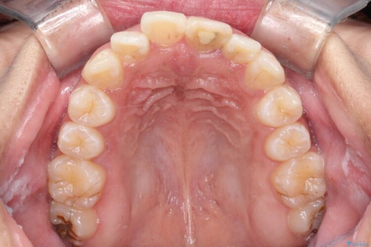 突出感のある口元、抜歯矯正で理想的な横顔に 治療前画像
