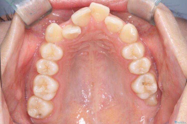 重なり合った歯列を整え、美しい横顔に 治療前画像