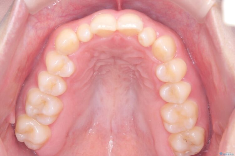 歯を削らない矮小歯を考慮した非抜歯矯正 治療前画像