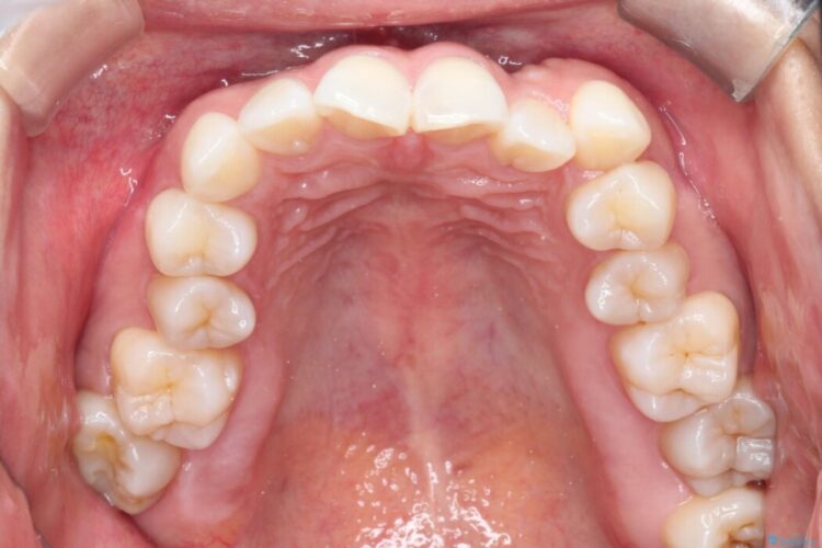 非抜歯で叢生とシザーズバイトの改善 治療前画像