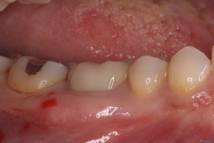 銀歯の下で進行した虫歯、セラミッククラウンでやり替え 治療前画像