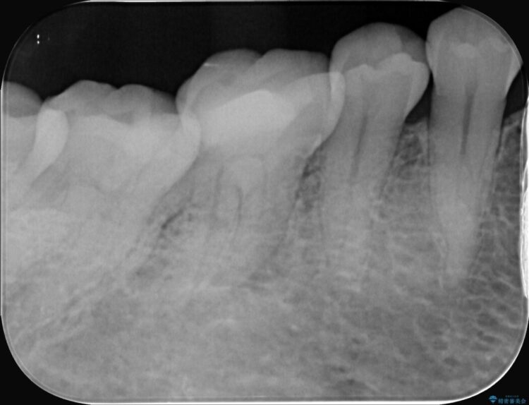 強い痛みと腫れを伴う「曲がった根っこ」を精密根管治療 治療前画像