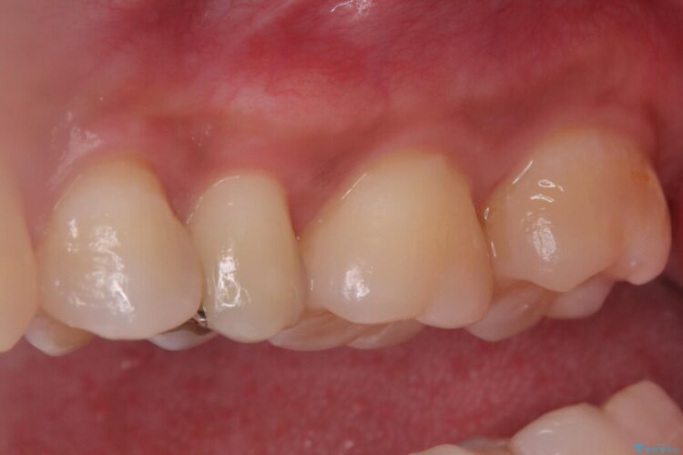 「痛み」を「安心」に。銀歯を外して行う、最新の精密根管治療 治療前画像